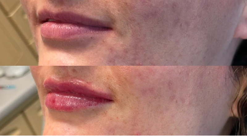 Nashville dermal fillers